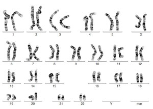 Weiblicher Karyotyp mit normaler chromosomaler Untersuchung 46,XY